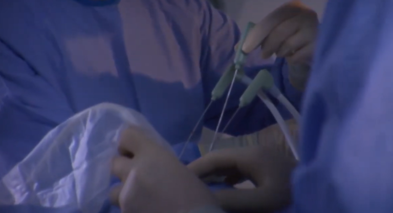 liver microwave ablation procedure